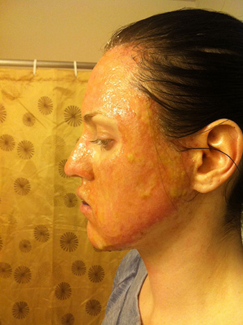 laser resurfacing laser resurfacing