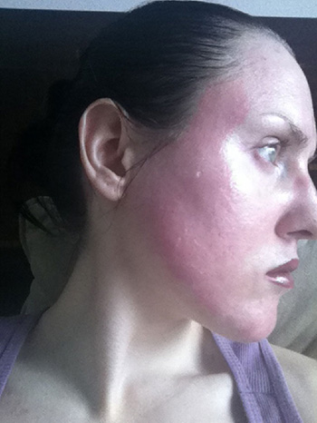 laser resurfacing photo 12 laser resurfacing photo bellevue seattle