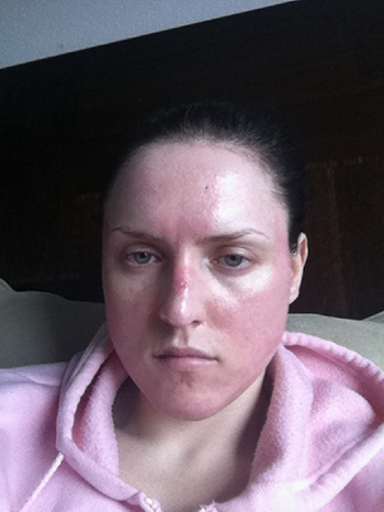laser resurfacing photo 11 laser resurfacing photo bellevue seattle