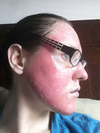 laser resurfacing photo 9 laser resurfacing photo bellevue seattle