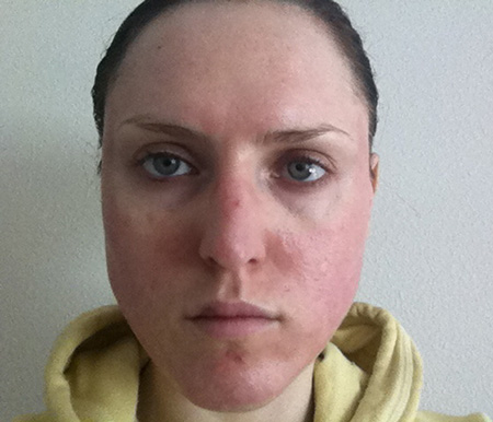 laser resurfacing photo 14 laser resurfacing photo bellevue seattle