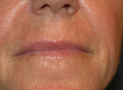 Laser resurfacing before Laser resurfacing before