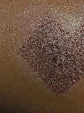 laser resurfacing photo 5 laser resurfacing photo bellevue seattle