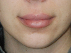 Lip injections after Lip injections after
