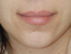 Lip injections before Lip injections before