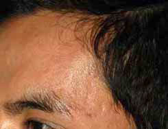 Microdermabrasion after Microdermabrasion after