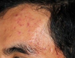 Microdermabrasion before Microdermabrasion before