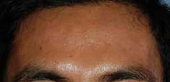 Microdermabrasion after Microdermabrasion after