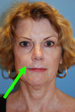 Nasolabial Folds Treatment Picture Diagram Nasolabial Folds Treatment Picture Diagram
