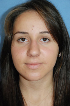 Rhinoplasty Before Rhinoplasty Before