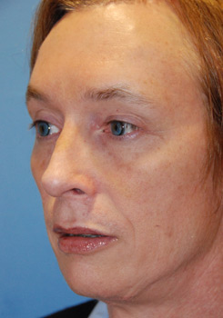 After Transgender Feminization Procedure After Transgender Feminization Procedure