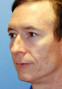 Before Transgender Feminization Procedure Before Transgender Feminization Procedure