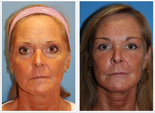 YoungVitalizer Incision Less Browlift YoungVitalizer Incision Less Browlift