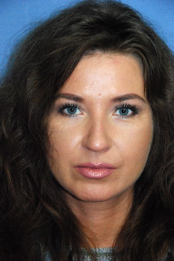 Eye Lift After Eye Lift After