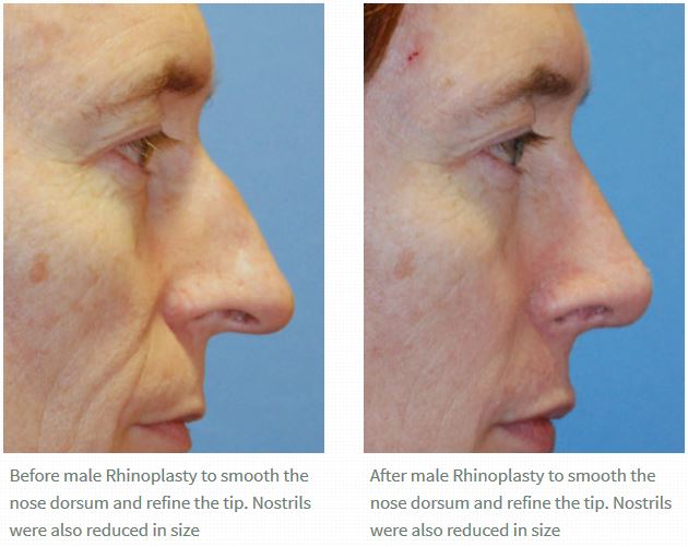 Wide Nose Rhinoplasty Before and After