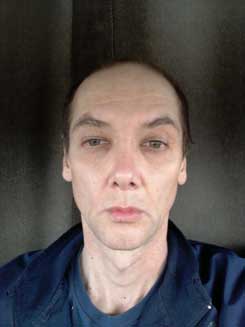 Transgender Rhinoplasty Lip VY Augmentation 2 months Front Transgender Rhinoplasty Lip VY Augmentation 2 months Front
