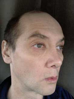 Transgender Rhinoplasty Lip VY Augmentation 2 months Right Oblique Transgender Rhinoplasty Lip VY Augmentation 2 months Right Oblique
