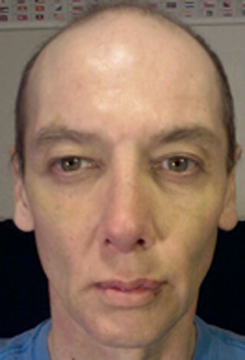 Transgender Rhinoplasty Lip VY Augmentation day 11 front Transgender Rhinoplasty Lip VY Augmentation day 11 front