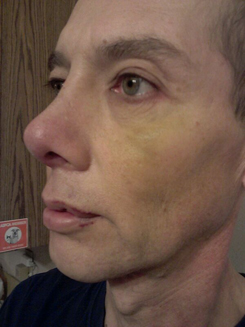 Transgender Rhinoplasty Lip VY Augmentation day 11 left oblique Transgender Rhinoplasty Lip VY Augmentation day 11 left oblique