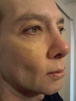 Transgender Rhinoplasty Lip VY Augmentation day 11 right oblique Transgender Rhinoplasty Lip VY Augmentation day 11 right oblique