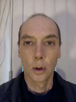 Transgender Rhinoplasty Lip VY Augmentation day 17 Front Transgender Rhinoplasty Lip VY Augmentation day 17 Front