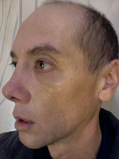 Transgender Rhinoplasty Lip VY Augmentation day 17 Left Oblique Transgender Rhinoplasty Lip VY Augmentation day 17 Left Oblique
