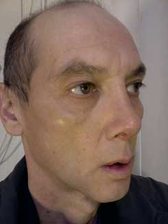 Transgender Rhinoplasty Lip VY Augmentation day 17 Right Oblique Transgender Rhinoplasty Lip VY Augmentation day 17 Right Oblique