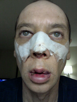 Transgender Rhinoplasty Lip VY Augmentation day 2 front Transgender Rhinoplasty Lip VY Augmentation day 2 front