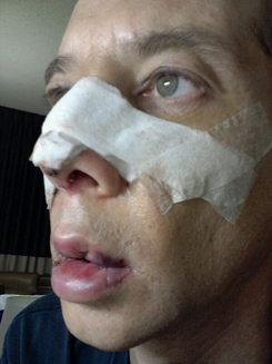 Transgender Rhinoplasty Lip VY Augmentation day 2 left oblique Transgender Rhinoplasty Lip VY Augmentation day 2 left oblique