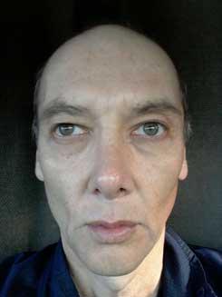 Transgender Rhinoplasty Lip VY Augmentation day 26 Front Transgender Rhinoplasty Lip VY Augmentation day 26 Front