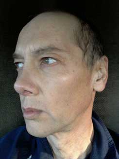 Transgender Rhinoplasty Lip VY Augmentation day 26 Left Oblique Transgender Rhinoplasty Lip VY Augmentation day 26 Left Oblique