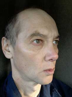 Transgender Rhinoplasty Lip VY Augmentation day 26 Right Oblique Transgender Rhinoplasty Lip VY Augmentation day 26 Right Oblique