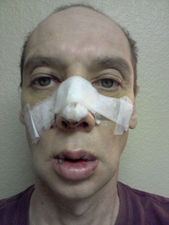 Transgender Rhinoplasty Lip VY Augmentation day 4 front Transgender Rhinoplasty Lip VY Augmentation day 4 front