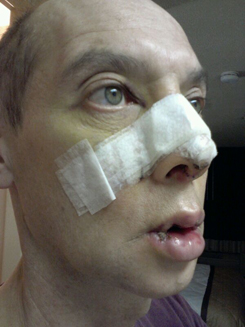 Transgender Rhinoplasty Lip VY Augmentation day 4right oblique Transgender Rhinoplasty Lip VY Augmentation day 4right oblique