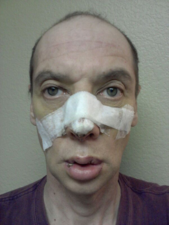 Transgender Rhinoplasty Lip VY Augmentation day 6 front Transgender Rhinoplasty Lip VY Augmentation day 6 front