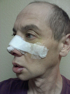 Transgender Rhinoplasty Lip VY Augmentation day 6 left oblique Transgender Rhinoplasty Lip VY Augmentation day 6 left oblique