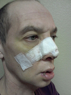 Transgender Rhinoplasty Lip VY Augmentation day 6 right oblique Transgender Rhinoplasty Lip VY Augmentation day 6 right oblique