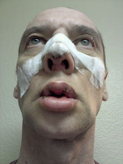Transgender Rhinoplasty Lip VY Augmentation day 6 view from below Transgender Rhinoplasty Lip VY Augmentation day 6 view from below