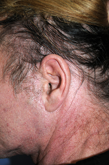 After Face and Necklift incisions in front and behind the ear 'After Face and Necklift incisions in front and behind the ear'