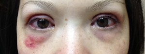 asian-double-eyelid-crease-photo-recovery-diary-day-20