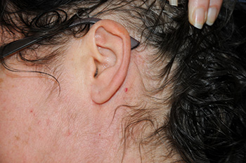 Images of Incision 6 months after Neck Lift Images of Incision 6 months after Neck Lift