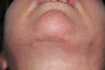 Images of Incision 6 months after Neck Lift
