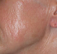 Before Chemical Peel Trichloroacetic Acid, Jessner's, Dermasanding Cheek Before Chemical Peel Trichloroacetic Acid, Jessner's, Dermasanding Cheek