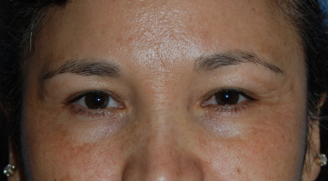 Fractional Laser Eyelid Lift Before Photo Close Up Fractional Laser Eyelid Lift Before Photo Close Up