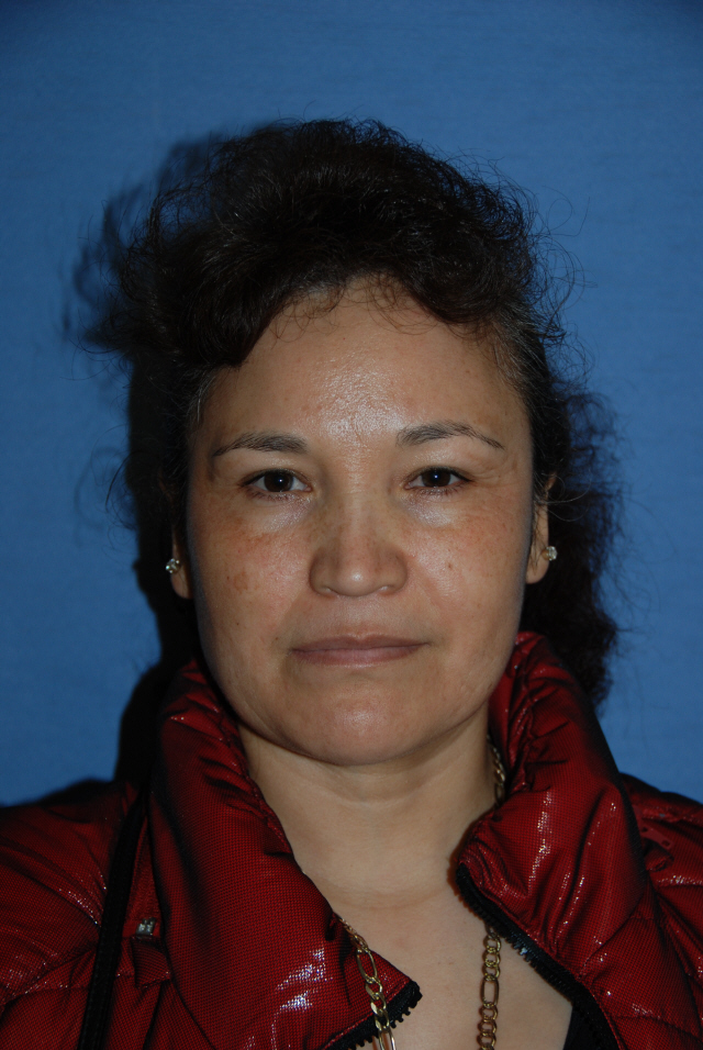 Fractional Laser Eyelid Lift Before Photo Fractional Laser Eyelid Lift Before Photo
