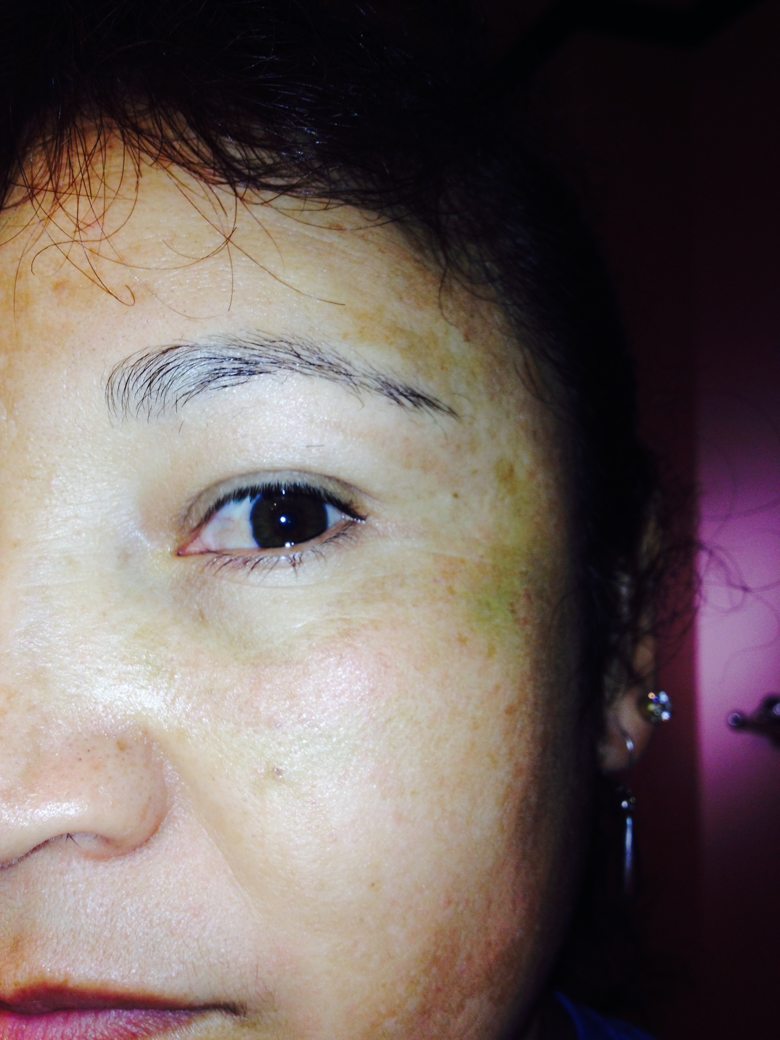 This is Day 10 after the Fractional Laser Eye Lift Left Oblique This is Day 10 after the Fractional Laser Eye Lift Left Oblique