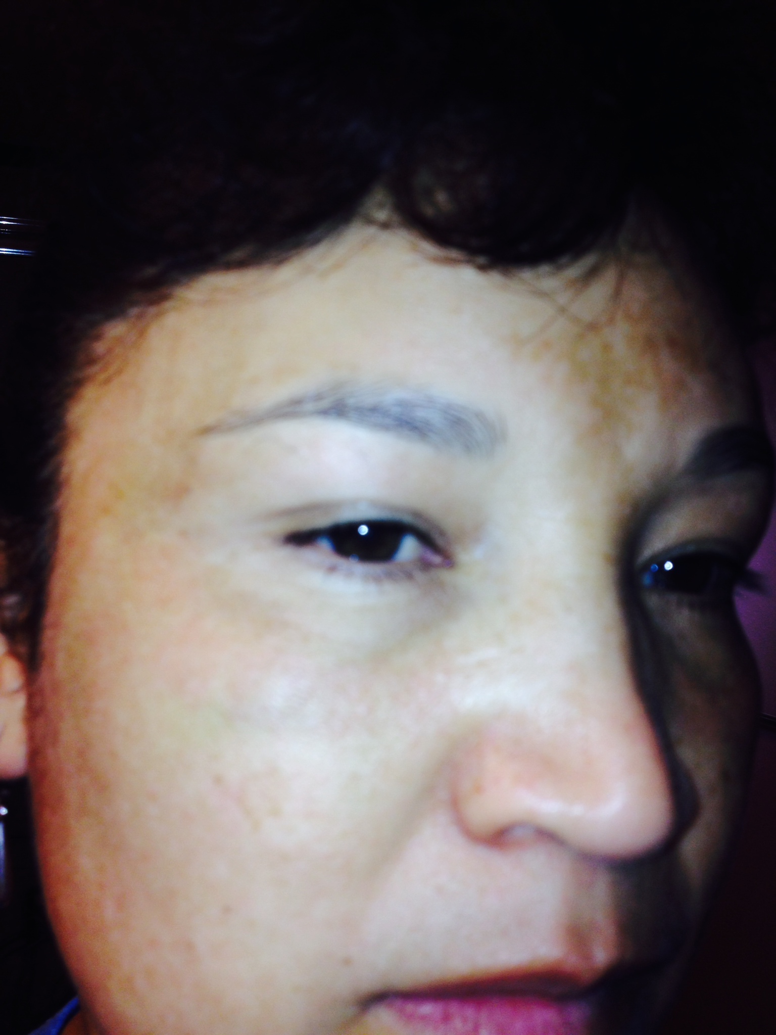 This is Day 10 after the Fractional Laser Eye Lift Right Eye Oblique This is Day 10 after the Fractional Laser Eye Lift Right Eye Oblique