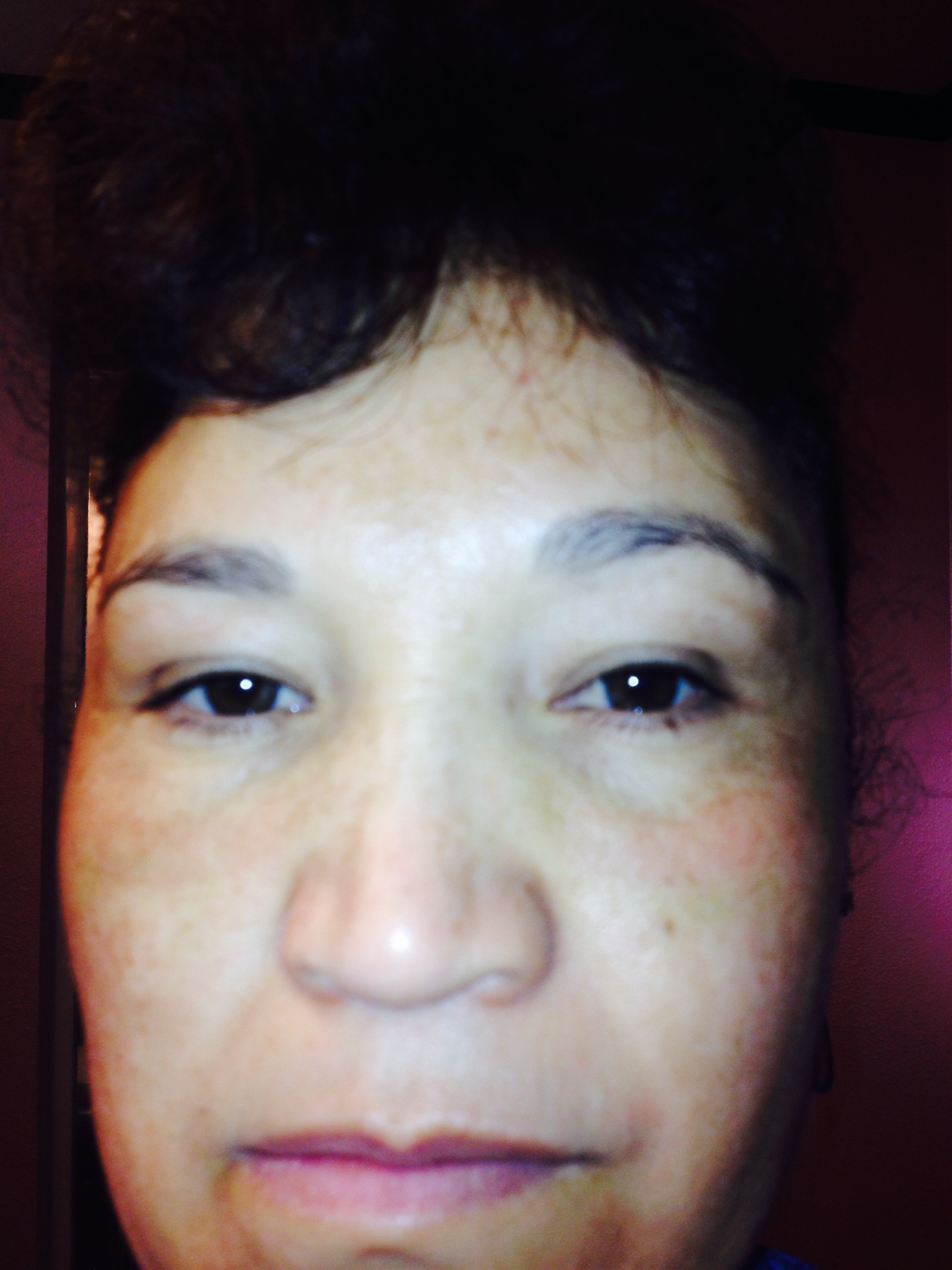 This is Day 10 after the Fractional Laser Eye Lift This is Day 10 after the Fractional Laser Eye Lift