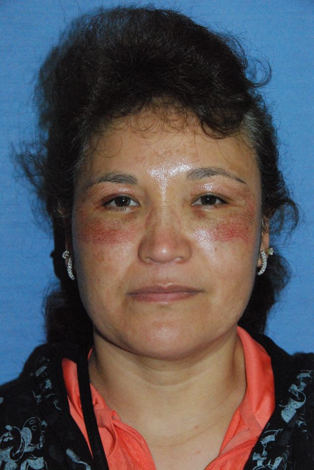 This is Day 2 after the Fractional Laser Eye Lift: This is Day 2 after the Fractional Laser Eye Lift:
