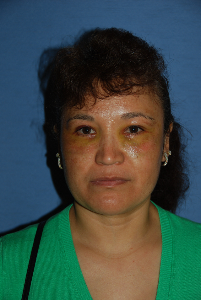 This is Day 4 after the Fractional Laser Eye Lift: This is Day 4 after the Fractional Laser Eye Lift: